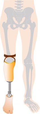 下腿義足PTB式の図