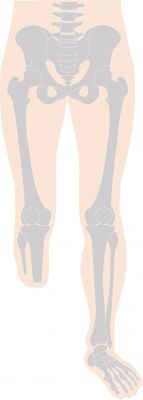 下腿切断の図