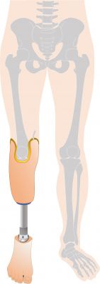 下腿義足KBM式の図
