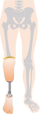 下腿義足PTS式の図