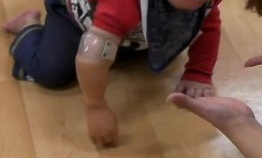 図1　義手をつけてのハイハイの写真
