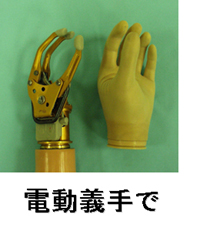 電動義手の写真
