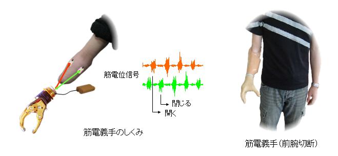 筋電義手の図
